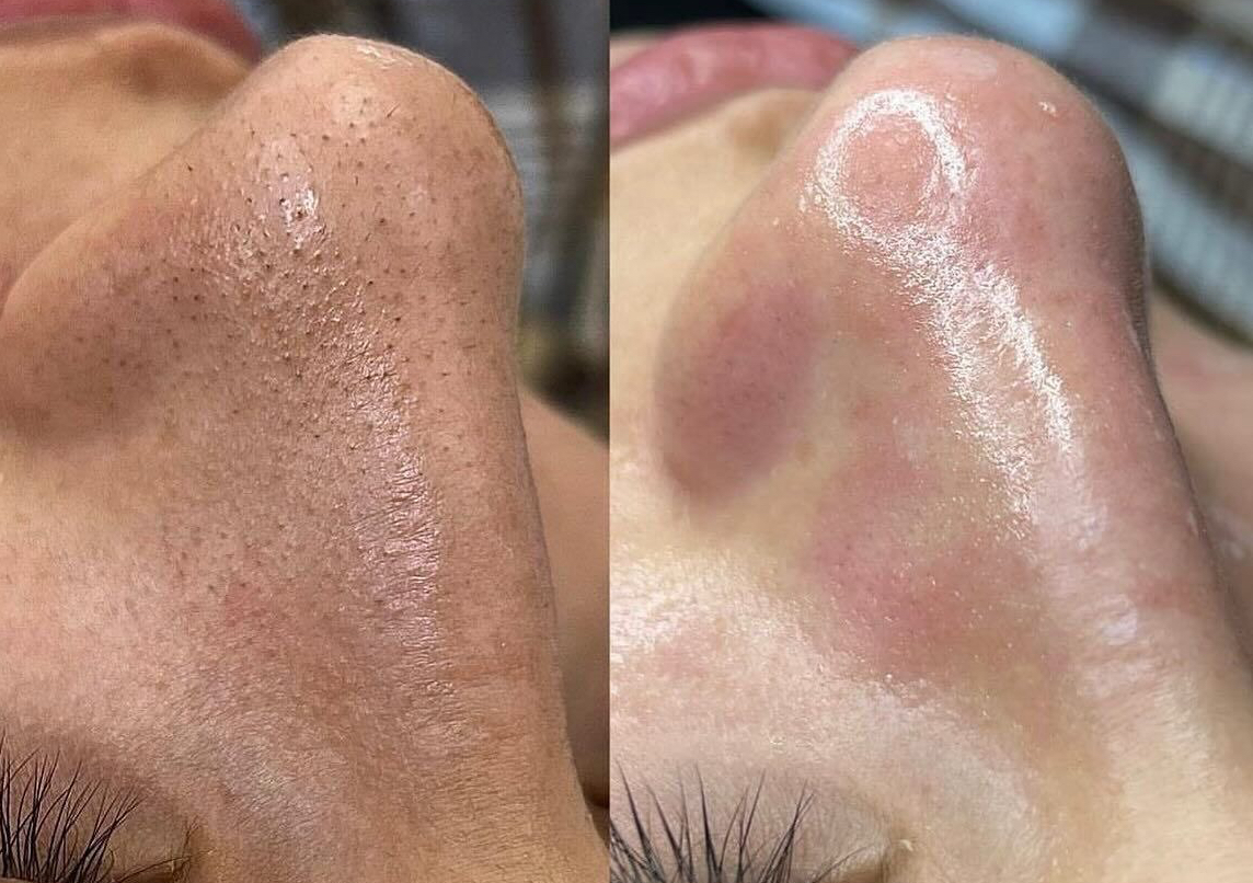 LIMPIEZA FACIAL PROFUNDA 