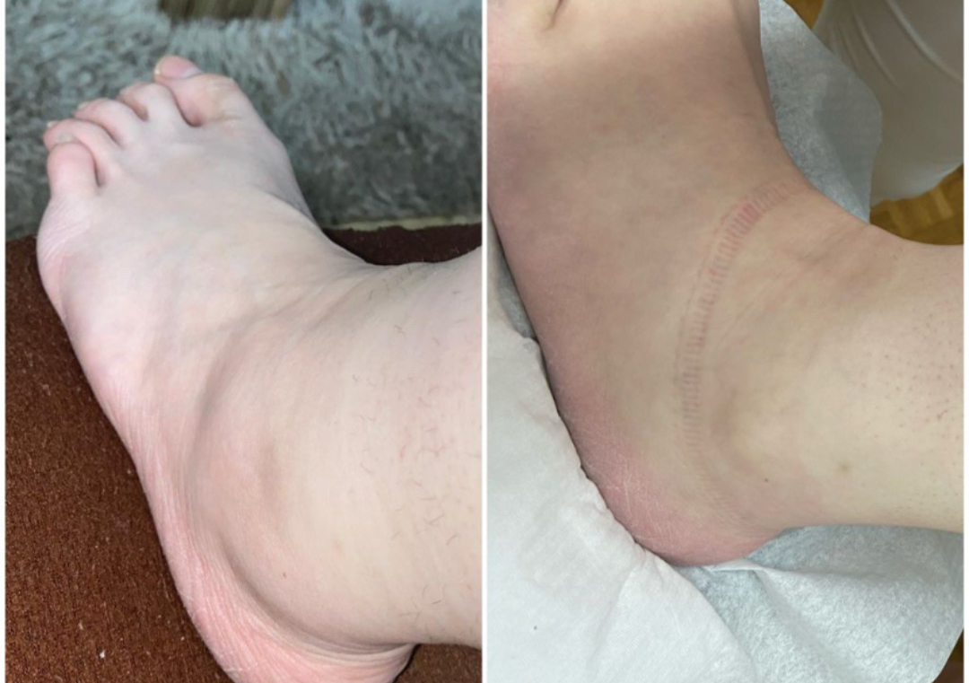 Körperlymphdrainage