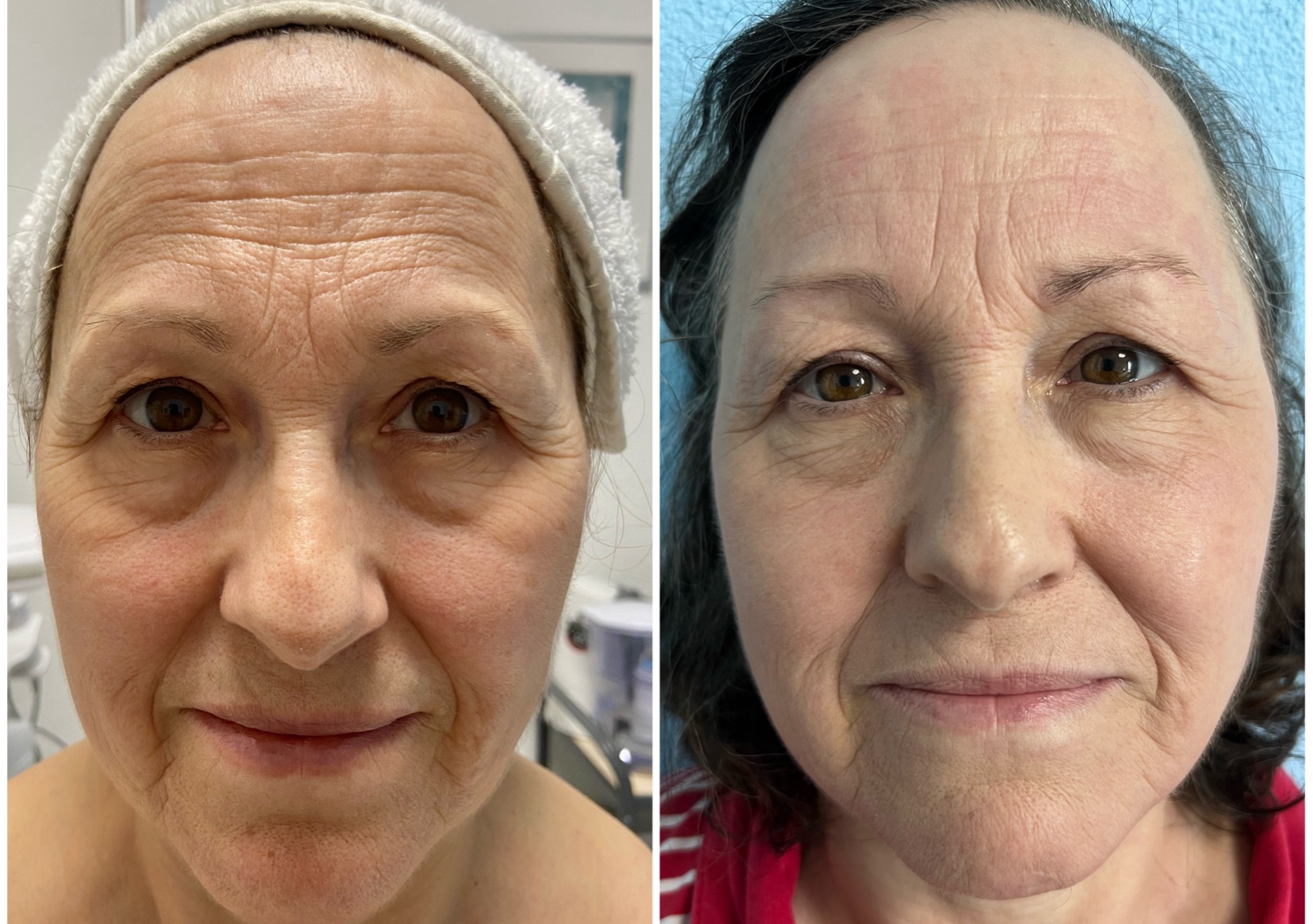  Mikroneedling (Kollagen-Biostimulator und Skin-Booster)