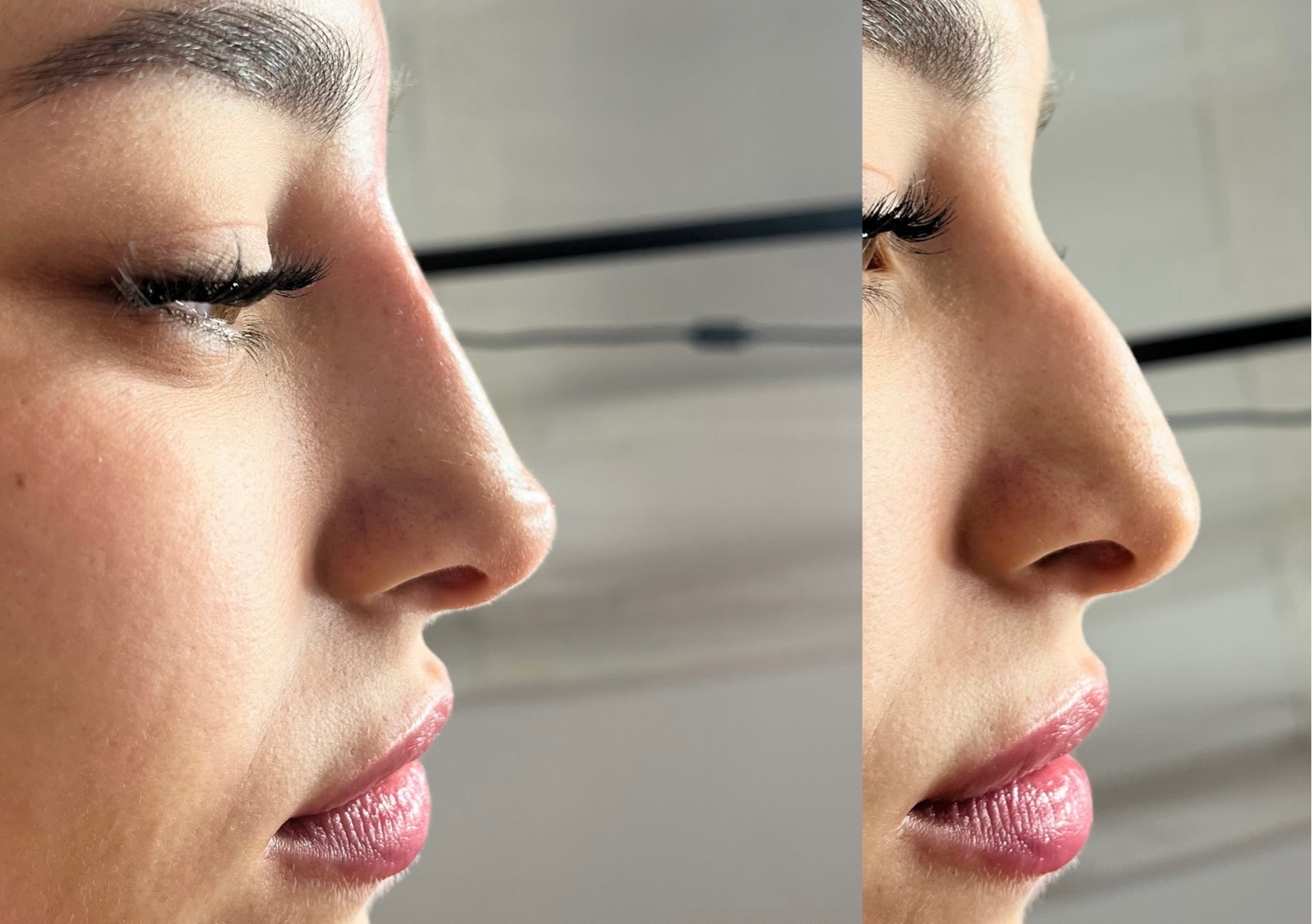 Non-Surgical Pixie Nose with Tip Lift