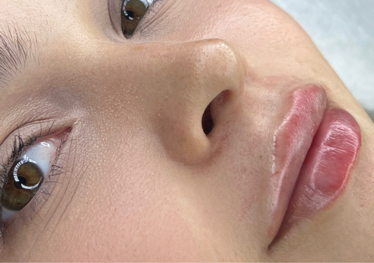 Aumento de labios 1ml