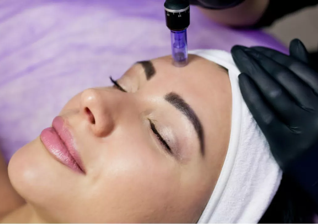 MICRONEEDLING ON FACE 