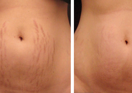 MICRONEEDLING ON STRECHMARKS 