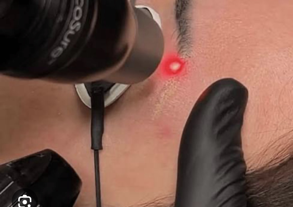 Remocion de cejas Tatuadas con laser (1 seccion) 