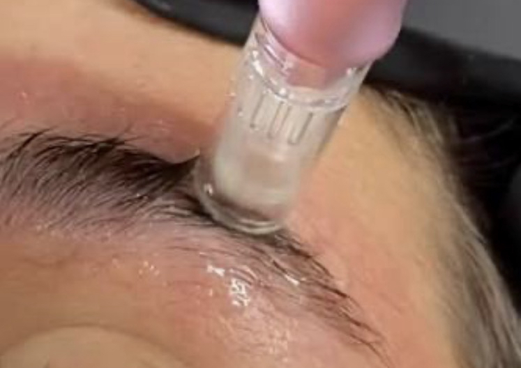 Restauracion de cejas
