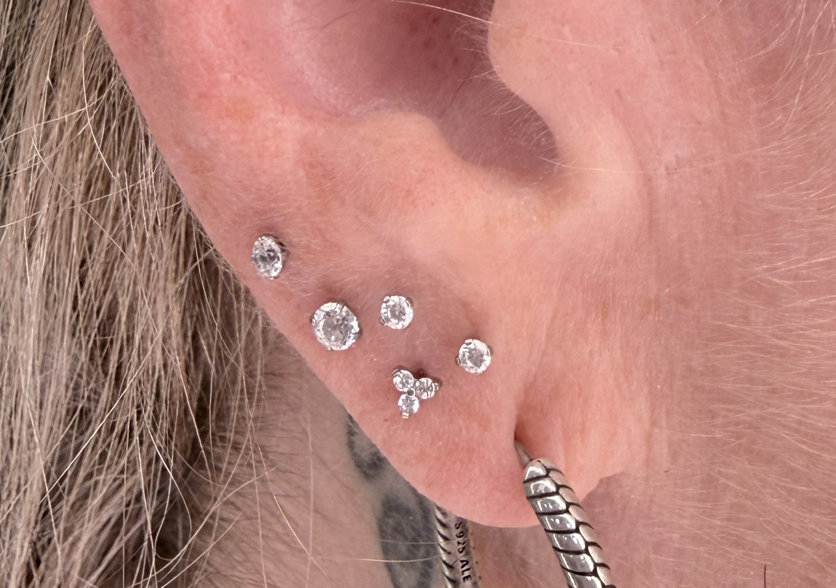 Stacked Lobes (both ears)  (2/3)