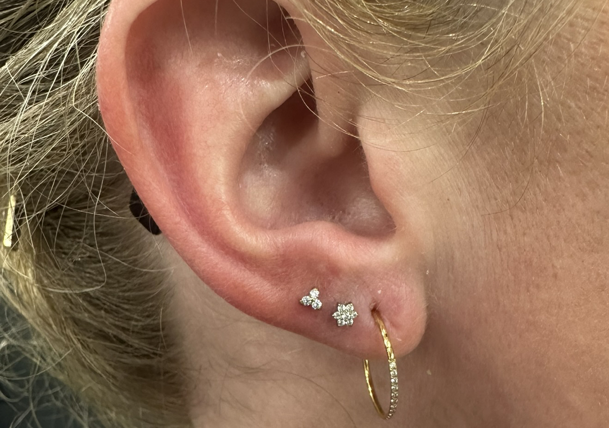 LOBES (both ears)  (3/3)