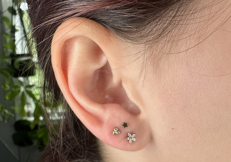 Stacked Lobes (both ears)  (3/3)