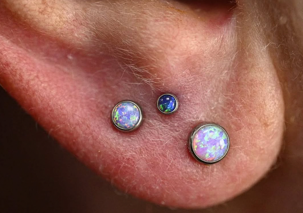 Stacked Lobes (both ears) 