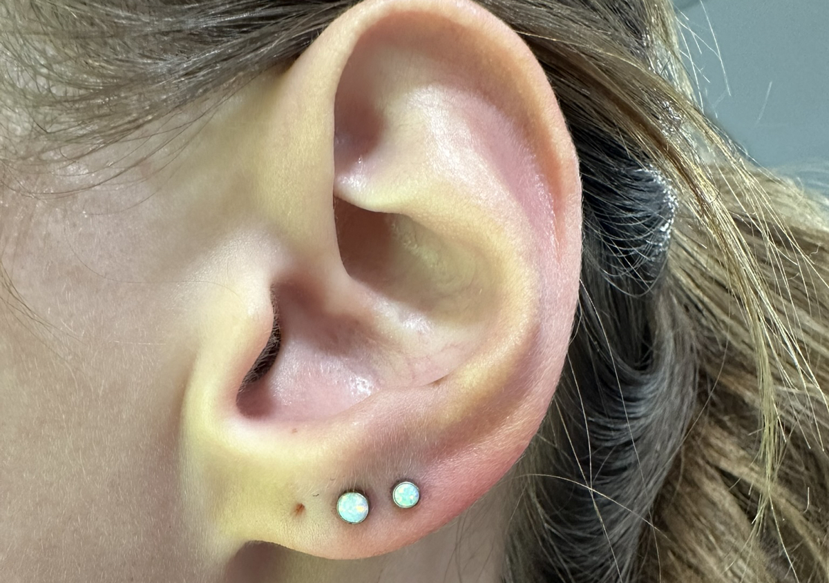 LOBES (both ears)  (2/3)