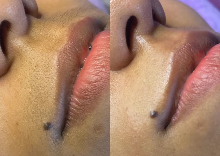 Depilacion con cera en bozo (bigote)