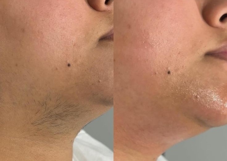 Depilacion con cera en mentón (barbilla)