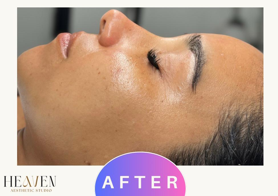 Dermaplaning + Ampula