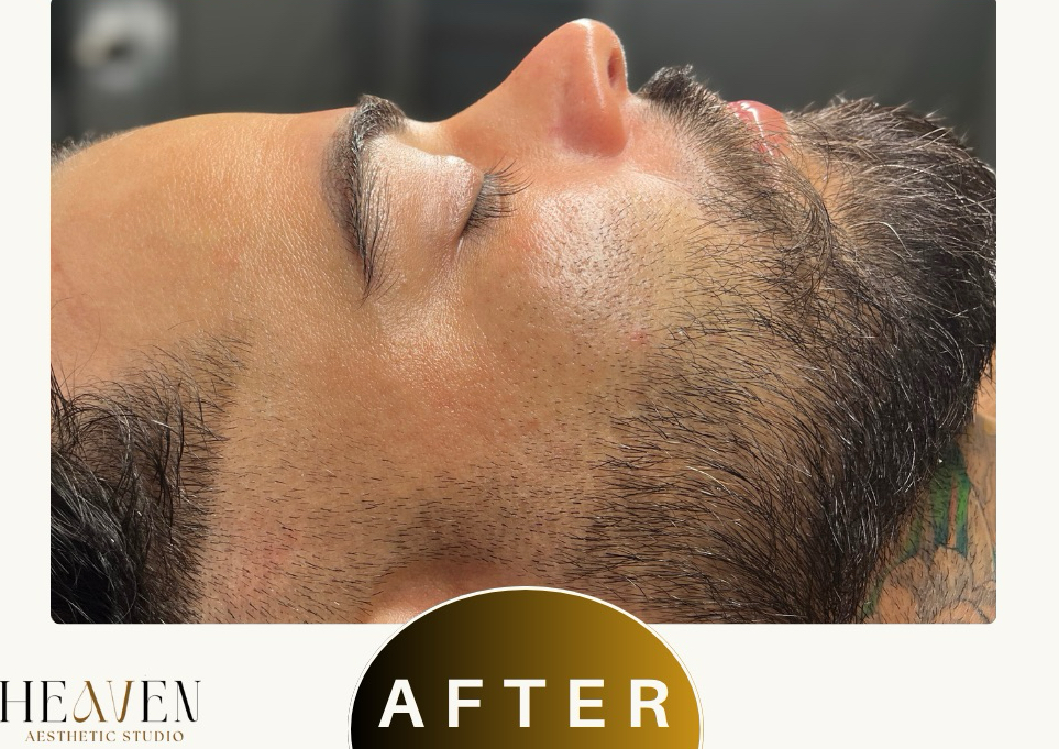 Microdermoabrasión + Deep Cleaning (incluye cuello y escote)