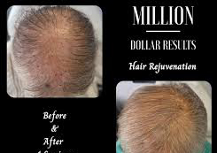 Hair rejuvenation (Million Dollar). Starter Package Available 