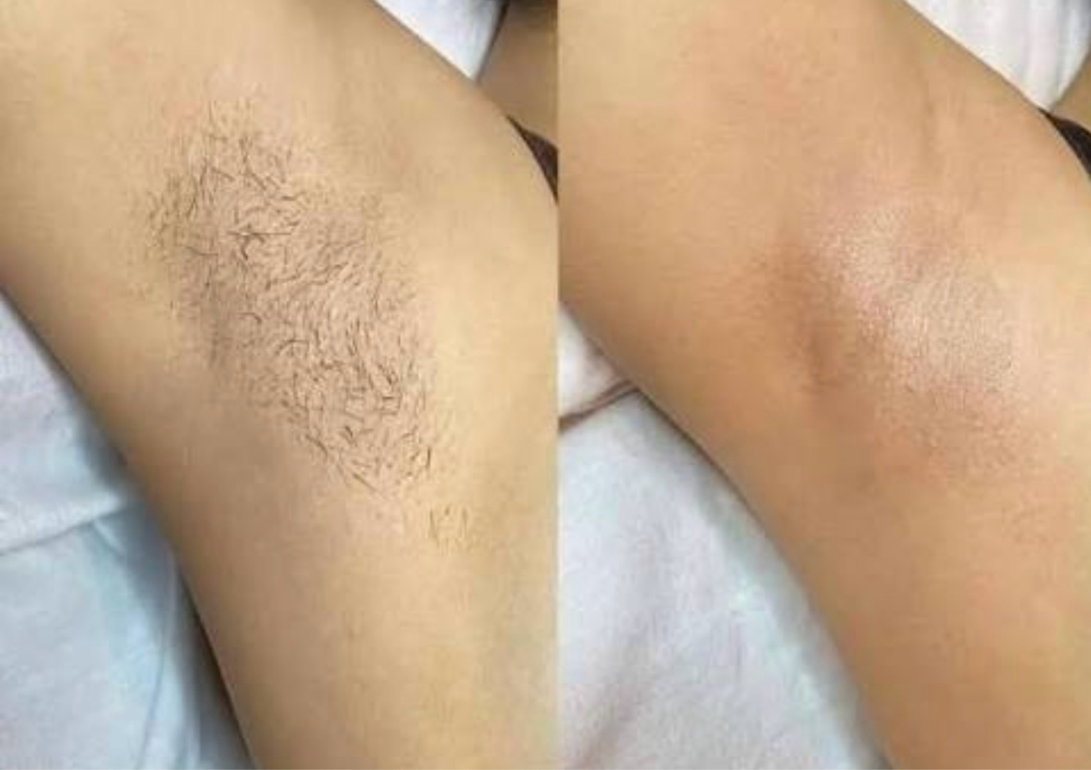 Laser hair removal for Underarm 