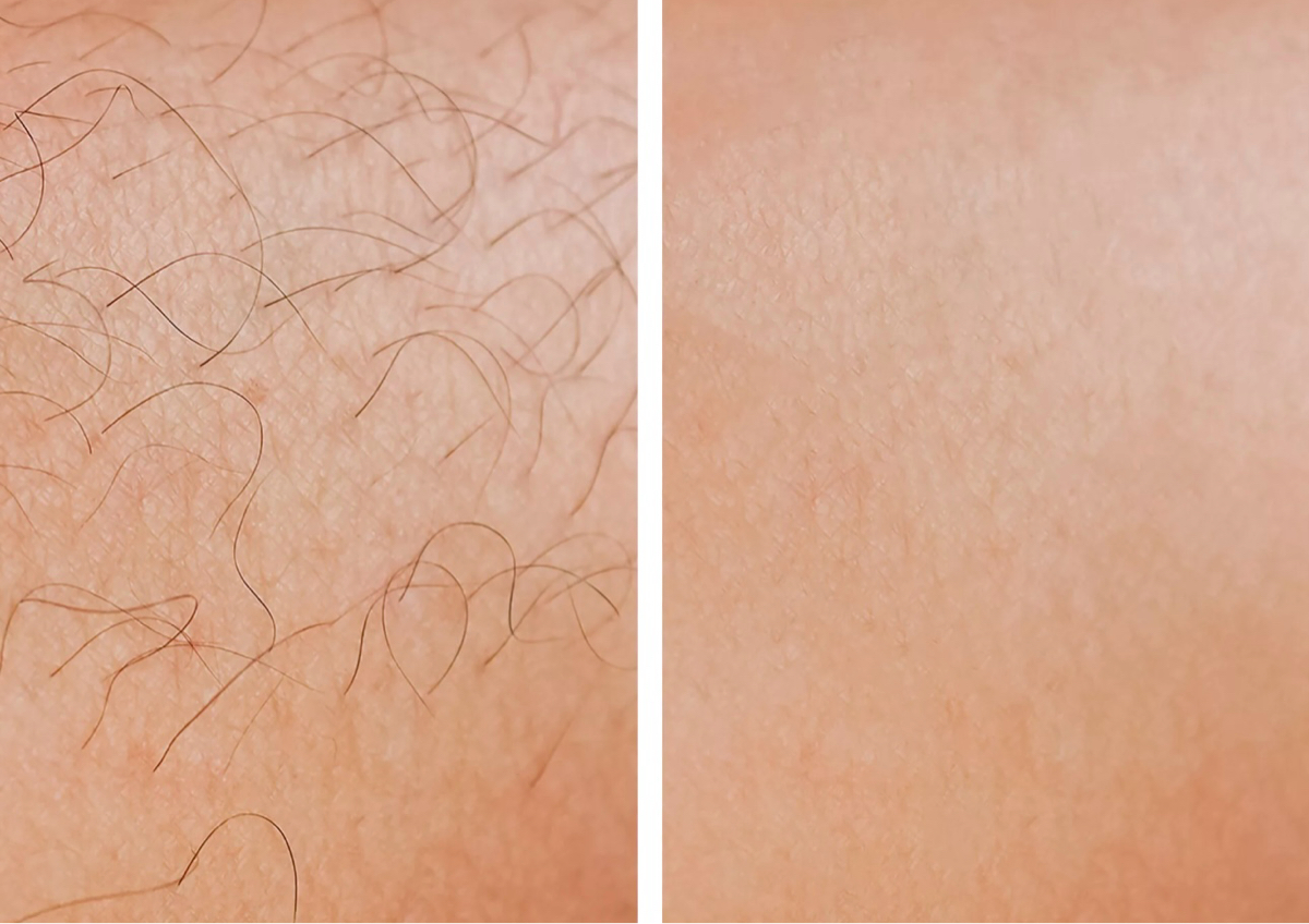 Laser hair removal for armpits 