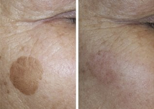 Laser freckles/seborrheic/keratosis( age spots)