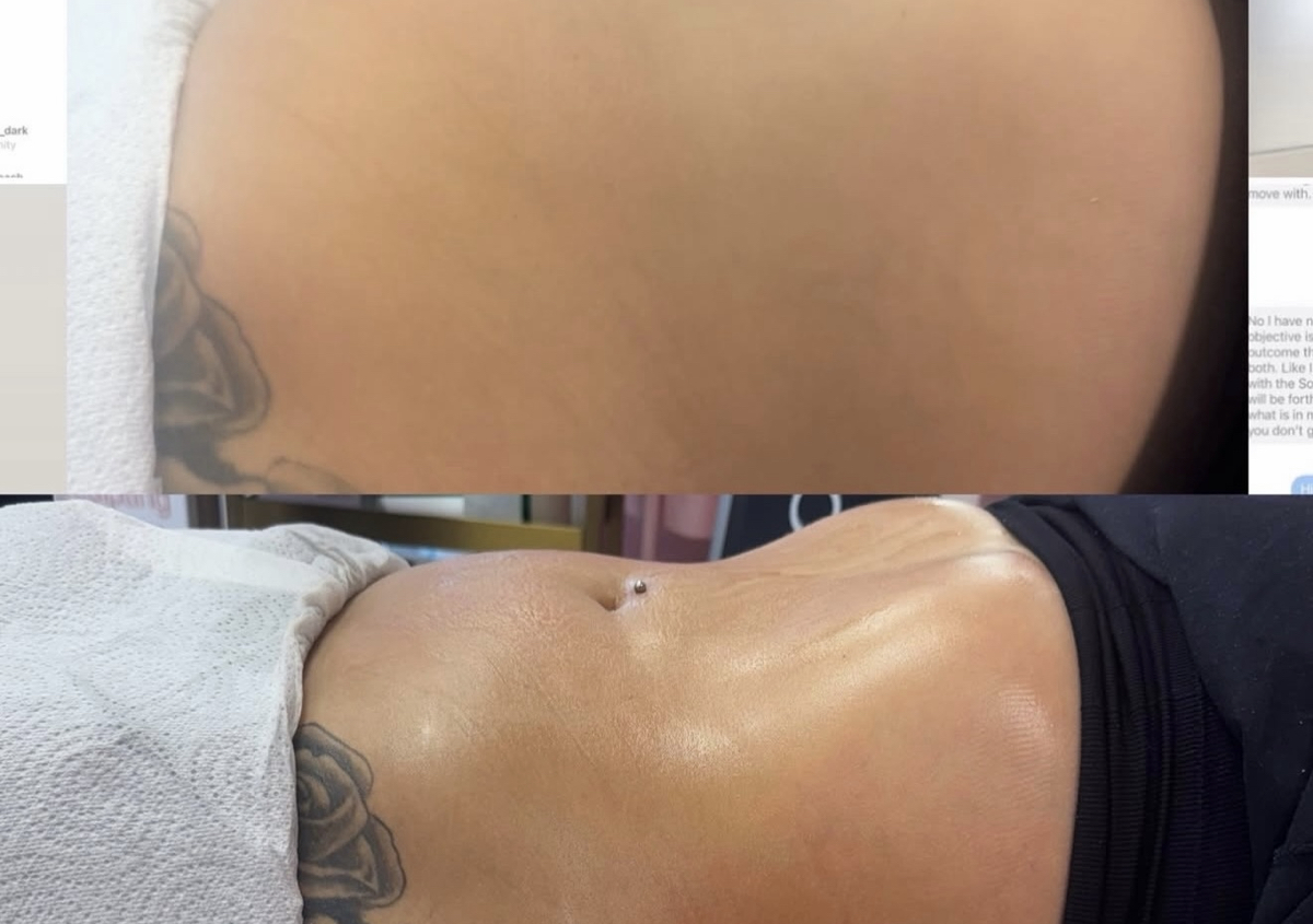 Tummy tuck 