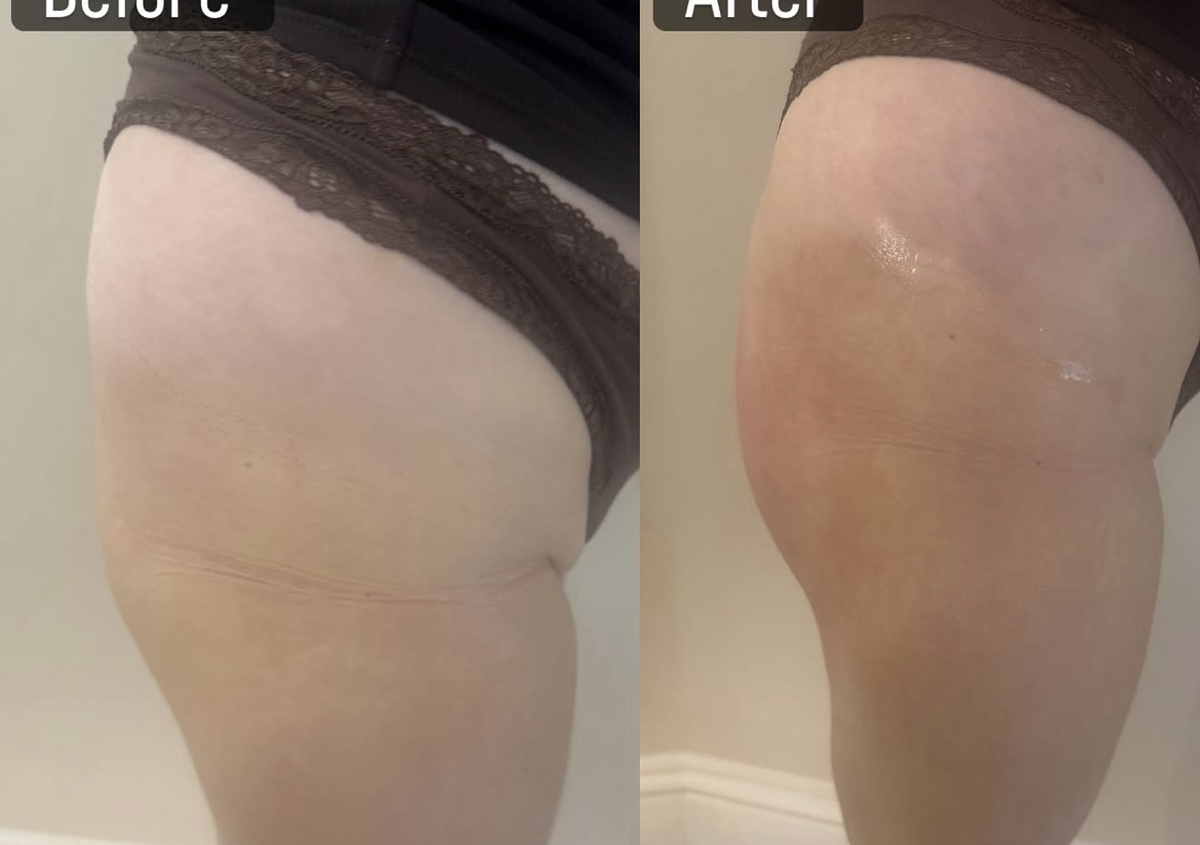 Non surgical BBL (2/2)