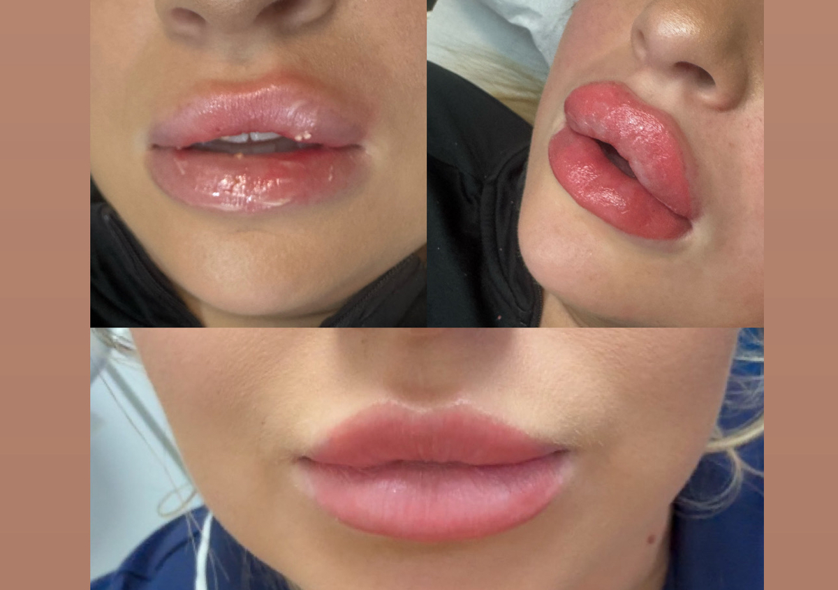 lip blush