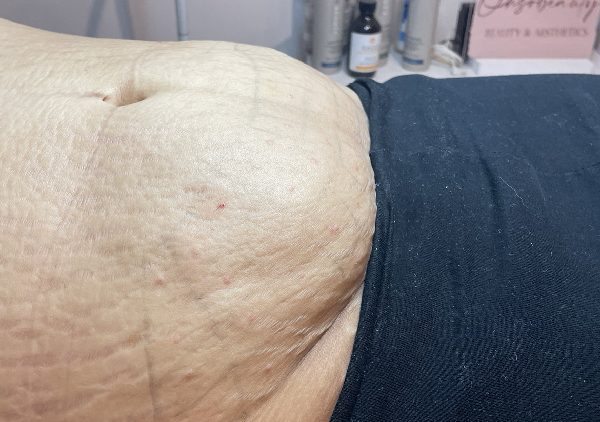 Microneedling Stretch marks