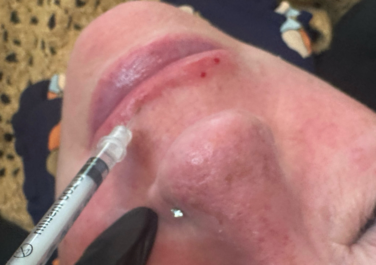 botox lip flip