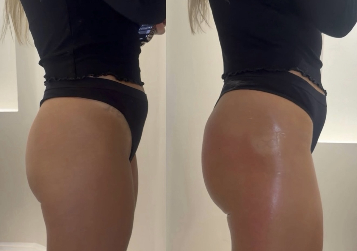 Non surgical BBL (1/2)