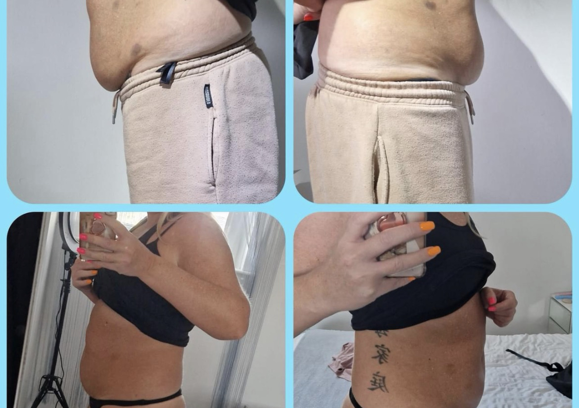 stomach fat dissolve