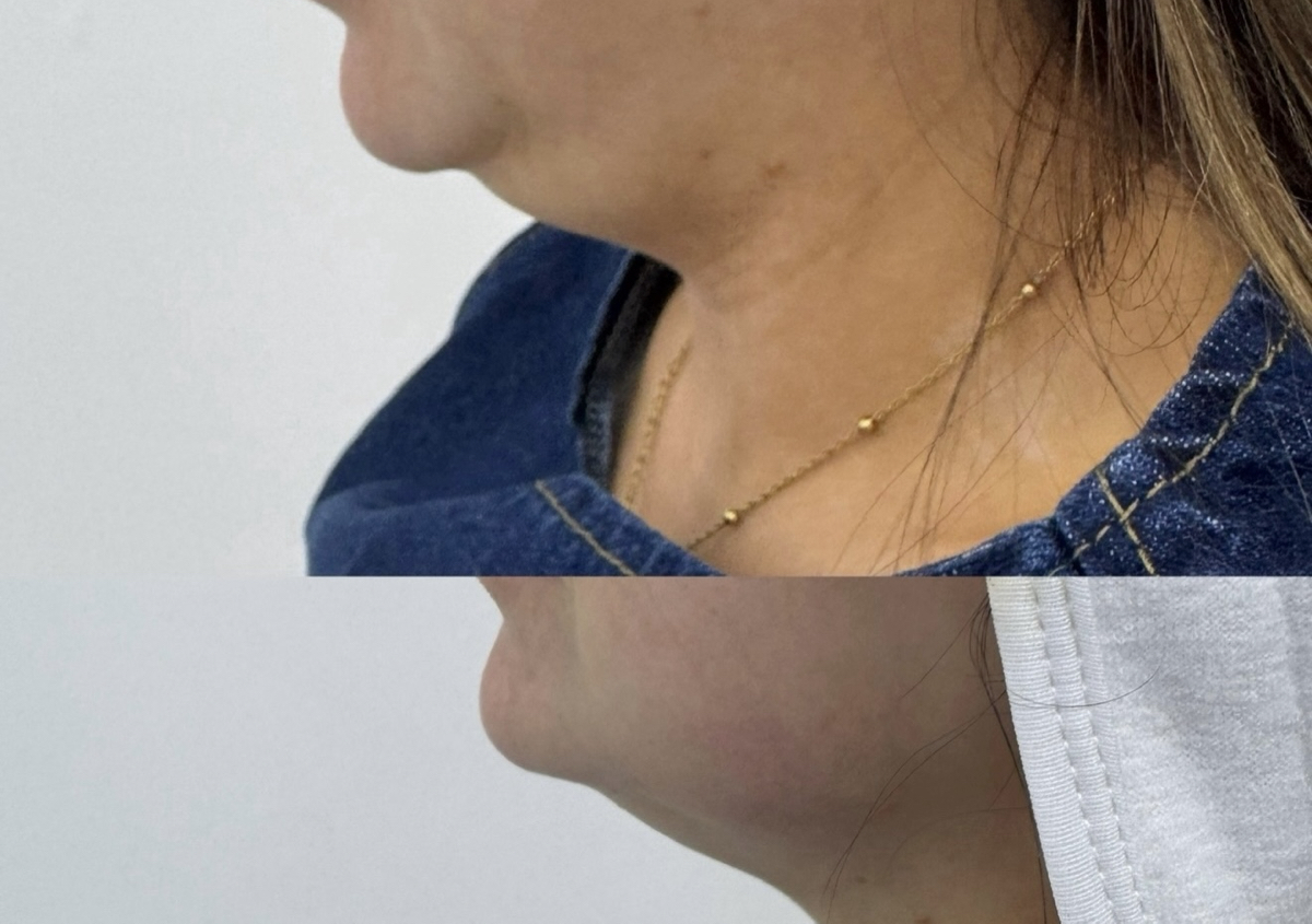 Non surgical face lift  (1/2)