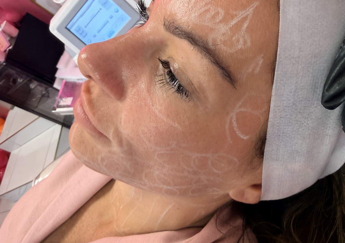 Non surgical face lift  (2/2)