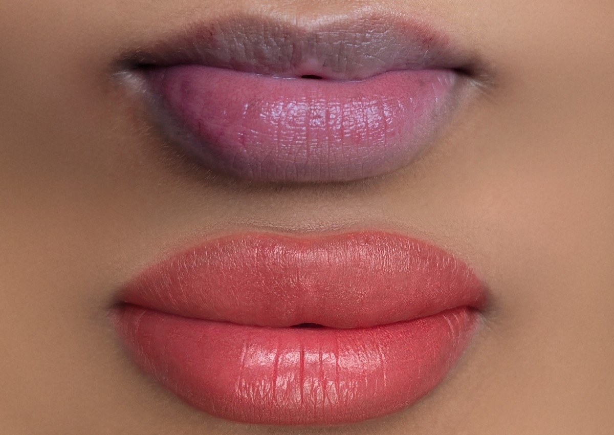 Dark Lips Neutralization