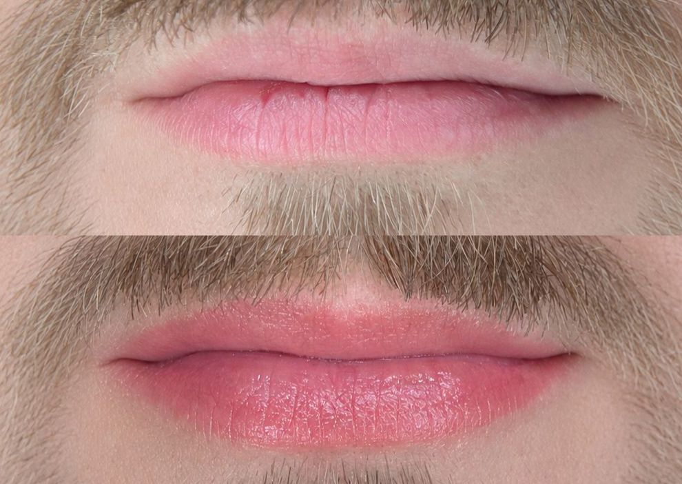 Men’s lip color correction & restoration