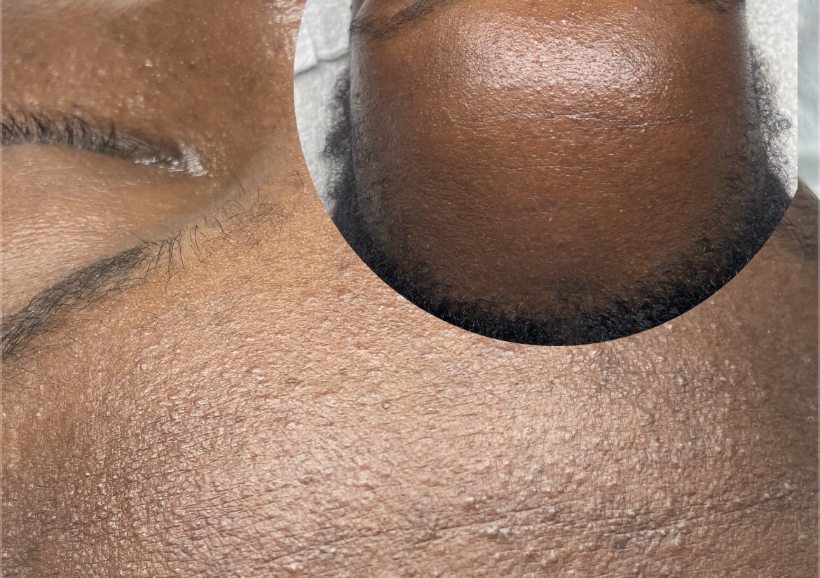 Acne Recovery Facial