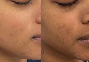 Salicylic Acid Peel (Face)