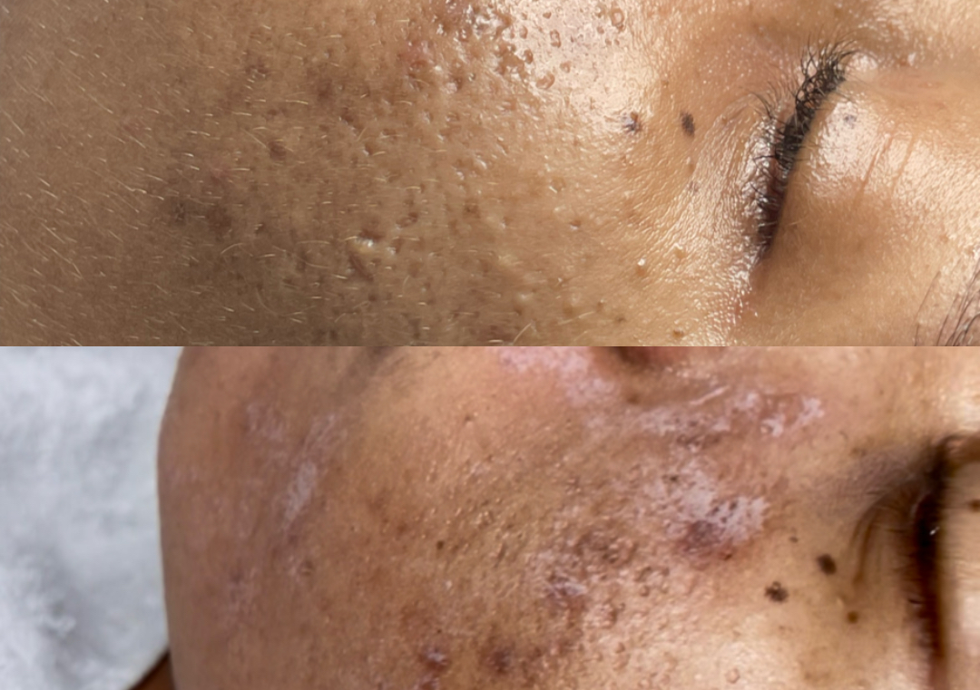 TCA PEEL (Face)