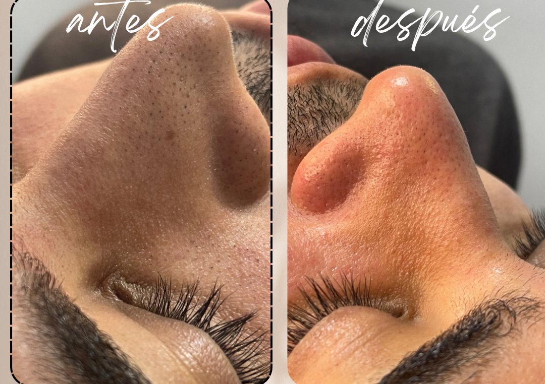 Limpieza facial  profundo