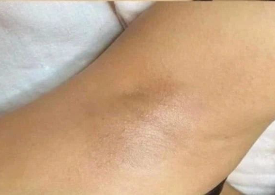 Depilación con cera en axilas 