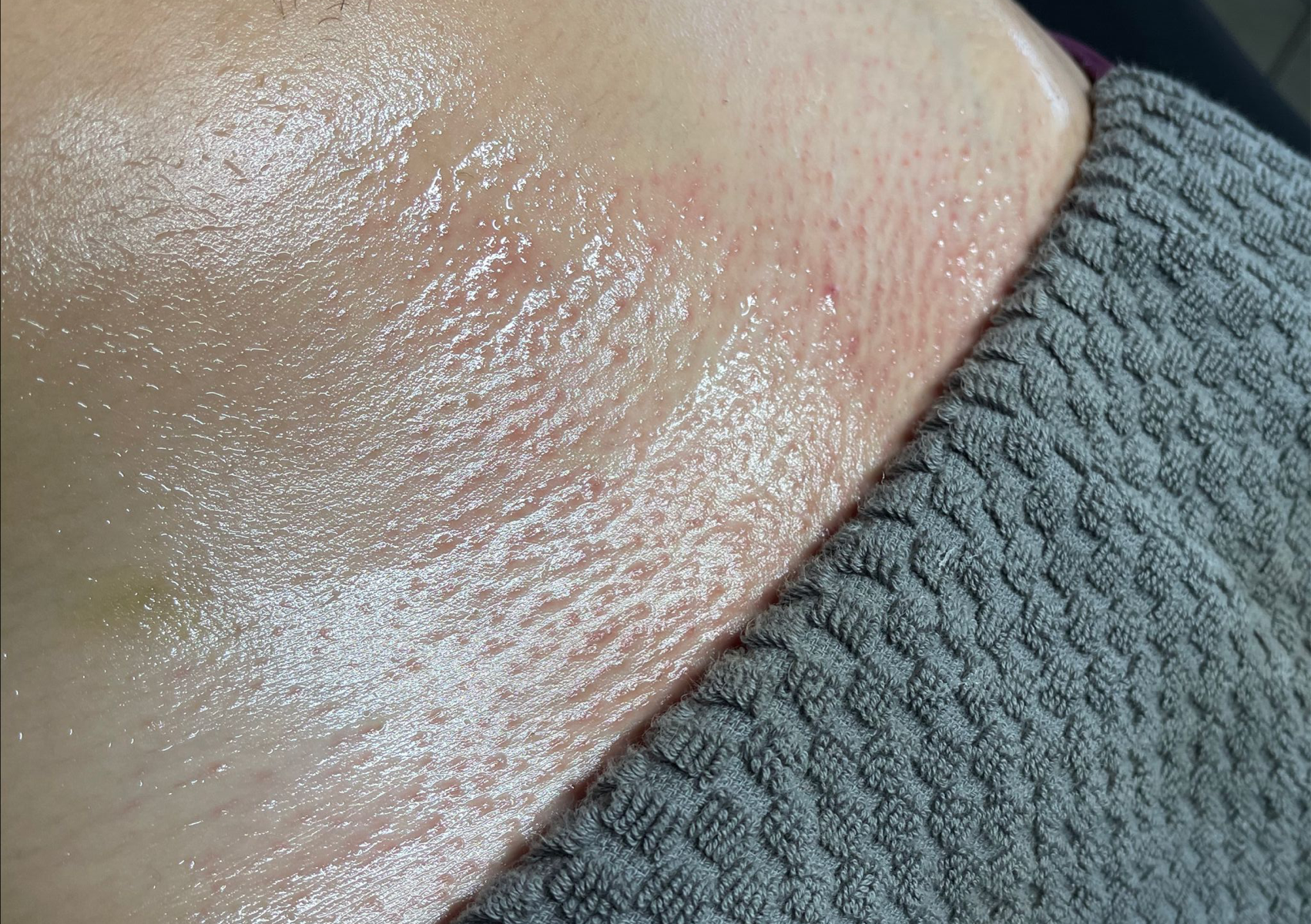 Bikini Line Re- Fresh 