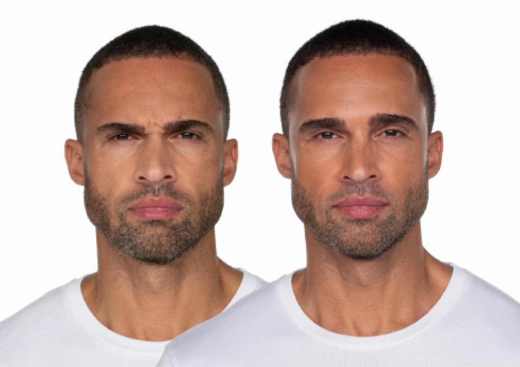 Toxin/Botox/Jeuveau with Dr Jae (1/3)