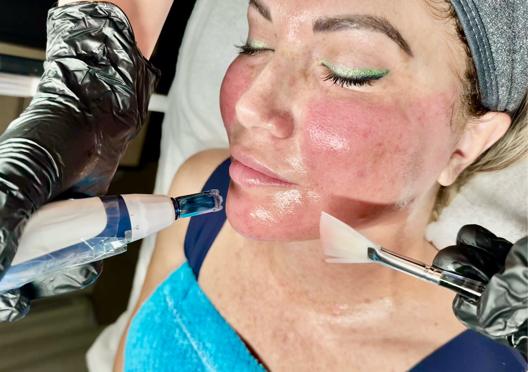 Medical microneedling 
