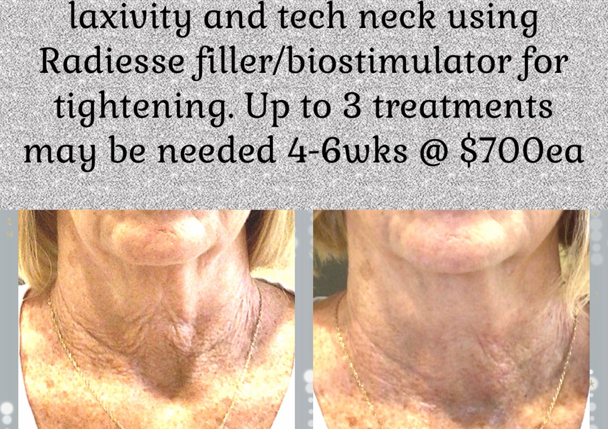 Nonsurgical neck lift