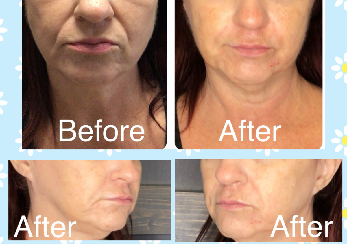 Cheek/Marionette/Nasolabial fold Filler