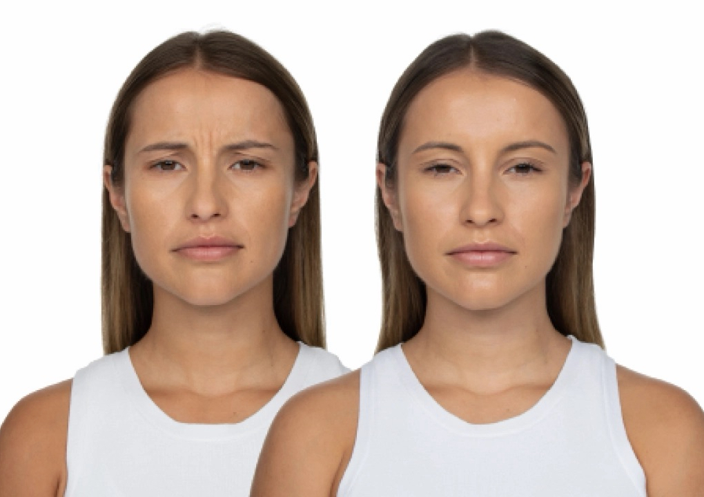 Toxin/Botox/Jeuveau with Dr Jae (3/3)