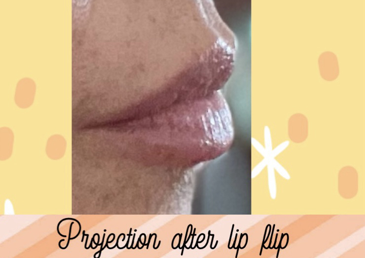 Lip flip 