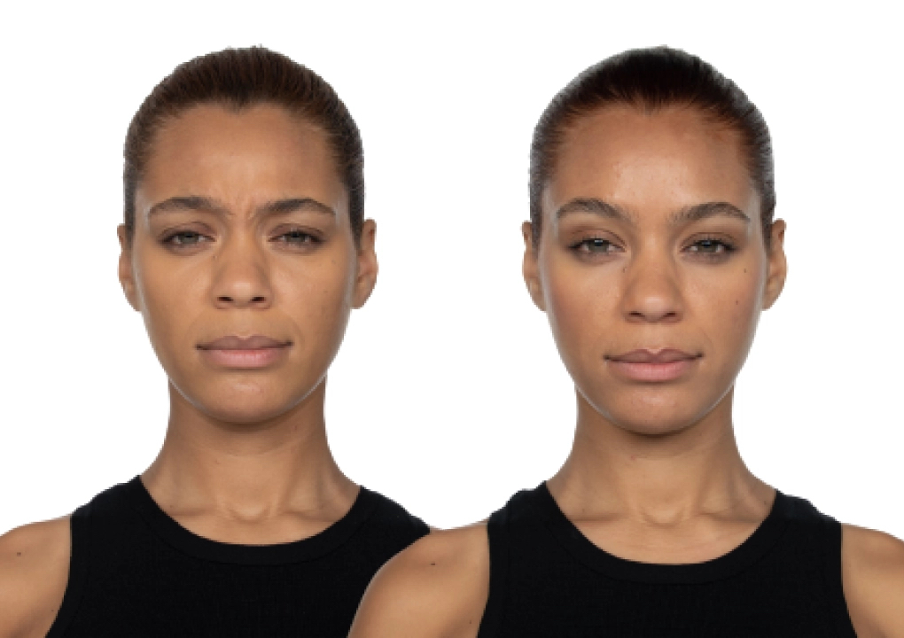 Toxin/Botox/Jeuveau  with injector Sherrie (3/3)