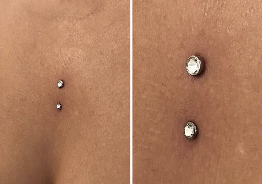 Mikro Dermal 