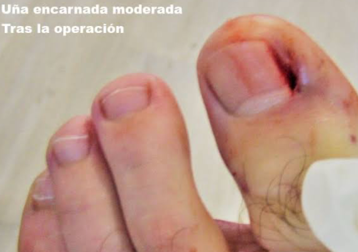 Matrisectomia quimica fenol alcohol
