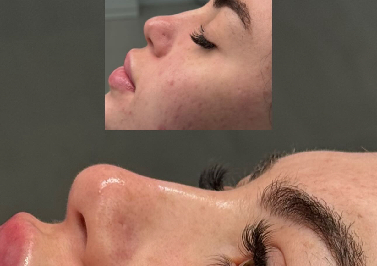 Non surgical rhinoplasty  