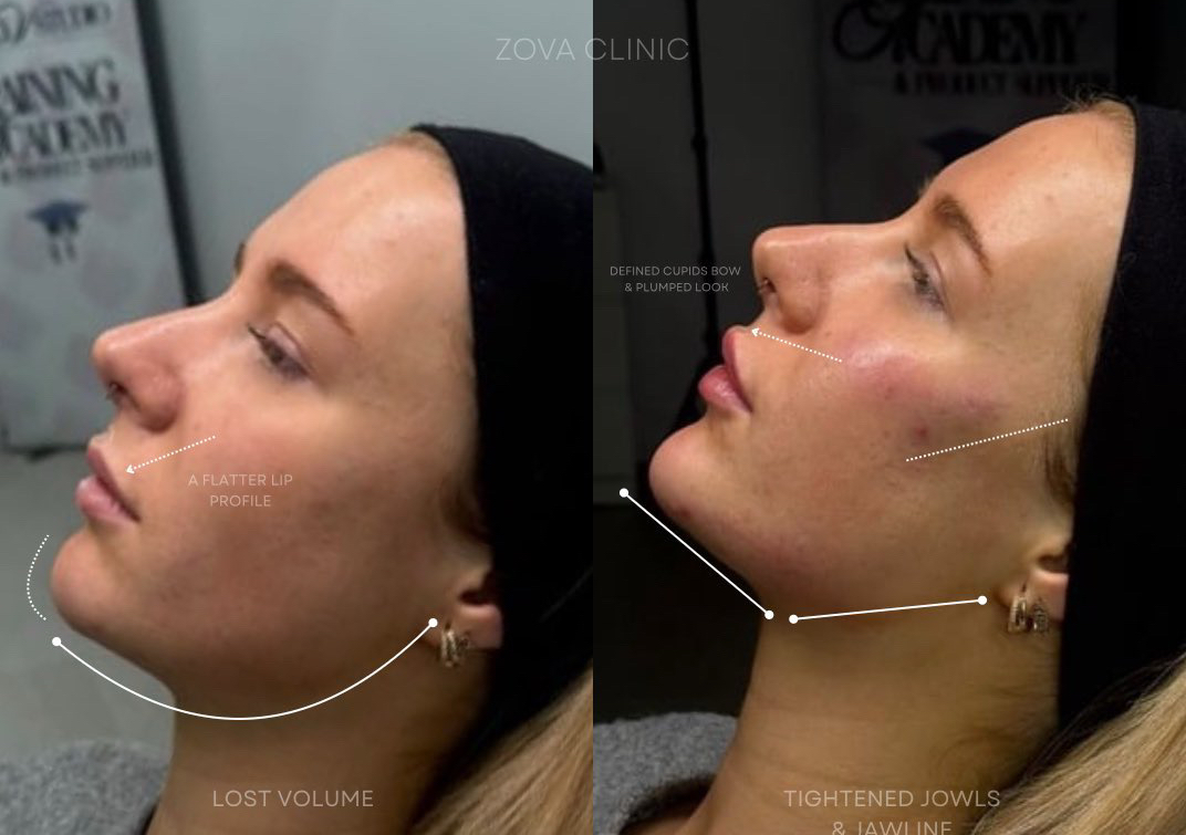 3.3ml filler package 